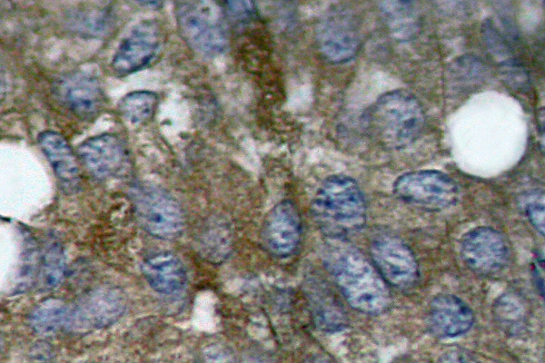 HSPB1 / HSP27 Antibody - IHC of p-HSP27 (S15) pAb in paraffin-embedded human lung carcinoma tissue.