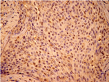 HSPB1 / HSP27 Antibody - Immunohistochemistry of human breast cancer tissue with Hsp27 (pSer15) pAb