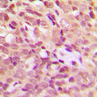 HSPB1 / HSP27 Antibody - Immunohistochemical analysis of HSP27 (pS15) staining in human breast cancer formalin fixed paraffin embedded tissue section. The section was pre-treated using heat mediated antigen retrieval with sodium citrate buffer (pH 6.0). The section was then incubated with the antibody at room temperature and detected using an HRP conjugated compact polymer system. DAB was used as the chromogen. The section was then counterstained with hematoxylin and mounted with DPX.