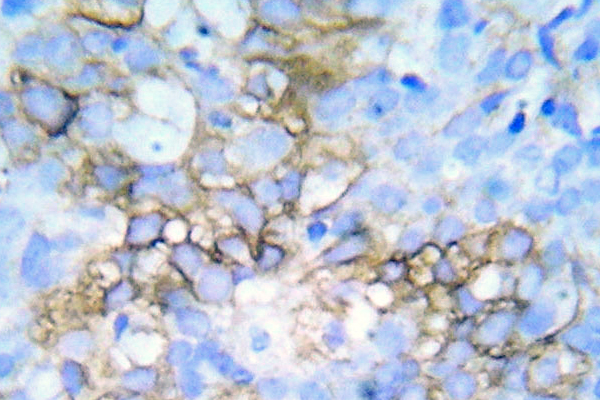 HSPB1 / HSP27 Antibody - Immunohistochemistry analyzsis of phospho-HSP27 (Phospho-Ser78/82) antibody in paraffin-embedded human breast carcinoma tissue.