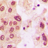 HSPB1 / HSP27 Antibody - Immunohistochemical analysis of HSP27 (pS82) staining in human lung cancer formalin fixed paraffin embedded tissue section. The section was pre-treated using heat mediated antigen retrieval with sodium citrate buffer (pH 6.0). The section was then incubated with the antibody at room temperature and detected using an HRP polymer system. DAB was used as the chromogen. The section was then counterstained with hematoxylin and mounted with DPX.