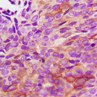 HSPB2 / HSP27 Antibody - Immunohistochemical analysis of HSPB2 staining in human renal cancer formalin fixed paraffin embedded tissue section. The section was pre-treated using heat mediated antigen retrieval with sodium citrate buffer (pH 6.0). The section was then incubated with the antibody at room temperature and detected with HRP and DAB as chromogen. The section was then counterstained with hematoxylin and mounted with DPX.