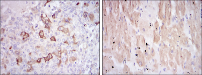 HSPB2 / HSP27 Antibody - IHC of paraffin-embedded breast cancer tissues (left) and cardiac muscle tissues (right) using HSP27 mouse monoclonal antibody with DAB staining.