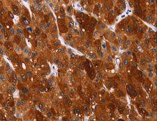 HSPB6 / HSP20 Antibody - Immunohistochemistry of paraffin-embedded Human gastric cancer using HSPB6 Polyclonal Antibody at dilution of 1:40.