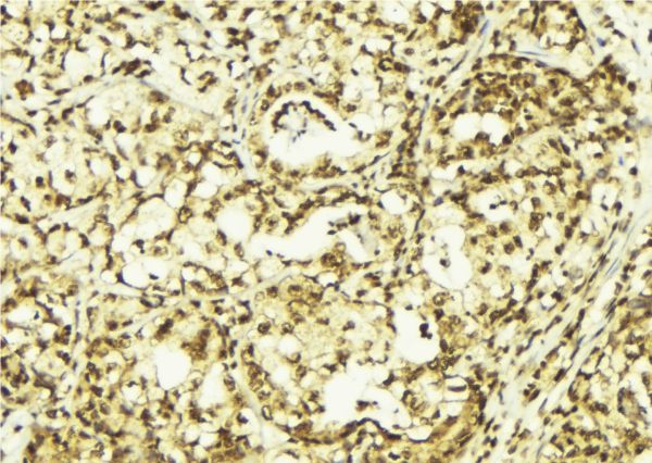 HSPB6 / HSP20 Antibody - 1:100 staining human breast carcinoma tissue by IHC-P. The sample was formaldehyde fixed and a heat mediated antigen retrieval step in citrate buffer was performed. The sample was then blocked and incubated with the antibody for 1.5 hours at 22°C. An HRP conjugated goat anti-rabbit antibody was used as the secondary.