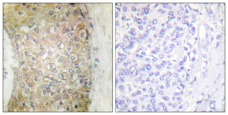 HSPB6 / HSP20 Antibody - Peptide - + Immunohistochemistry analysis of paraffin-embedded human breast carcinoma tissue using HSP20 antibody.