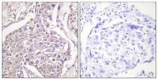 HSPB6 / HSP20 Antibody - P-peptide - + Immunohistochemistry analysis of paraffin-embedded human breast carcinoma tissue using HSP20 (Phospho-Ser16) antibody.
