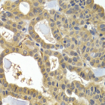 HSPB8 / H11 / HSP22 Antibody - Immunohistochemistry of paraffin-embedded human thyroid cancer tissue.