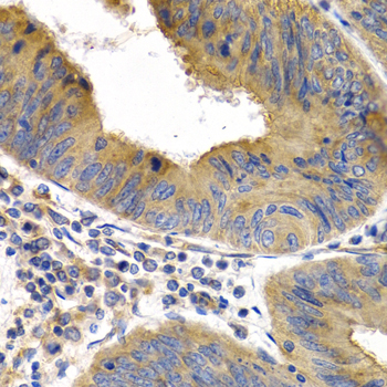 HSPB8 / H11 / HSP22 Antibody - Immunohistochemistry of paraffin-embedded human colon cancer tissue.