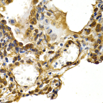 HSPB8 / H11 / HSP22 Antibody - Immunohistochemistry of paraffin-embedded human lung cancer tissue.