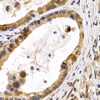 HSPB8 / H11 / HSP22 Antibody - Immunohistochemistry of paraffin-embedded human stomach cancer tissue.