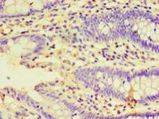 HSPBAP1 Antibody - Immunohistochemistry of paraffin-embedded human colon cancer using antibody at 1:100 dilution.  This image was taken for the unconjugated form of this product. Other forms have not been tested.