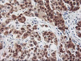 HSPBP1 Antibody - IHC of paraffin-embedded Carcinoma of Human lung tissue using anti-HSPBP1 mouse monoclonal antibody. (Heat-induced epitope retrieval by 10mM citric buffer, pH6.0, 100C for 10min).