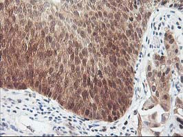 HSPBP1 Antibody - IHC of paraffin-embedded Carcinoma of Human bladder tissue using anti-HSPBP1 mouse monoclonal antibody. (Heat-induced epitope retrieval by 10mM citric buffer, pH6.0, 100C for 10min).