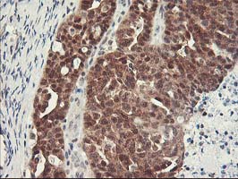 HSPBP1 Antibody - IHC of paraffin-embedded Adenocarcinoma of Human ovary tissue using anti-HSPBP1 mouse monoclonal antibody. (Heat-induced epitope retrieval by 10mM citric buffer, pH6.0, 100C for 10min).