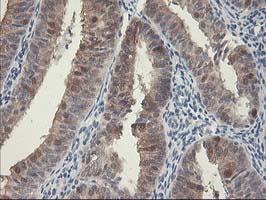 HSPBP1 Antibody - IHC of paraffin-embedded Adenocarcinoma of Human endometrium tissue using anti-HSPBP1 mouse monoclonal antibody. (Heat-induced epitope retrieval by 10mM citric buffer, pH6.0, 100C for 10min).