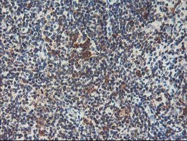 HSPBP1 Antibody - IHC of paraffin-embedded Human lymphoma tissue using anti-HSPBP1 mouse monoclonal antibody. (Heat-induced epitope retrieval by 10mM citric buffer, pH6.0, 100C for 10min).