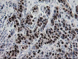 HSPBP1 Antibody - IHC of paraffin-embedded Carcinoma of Human lung tissue using anti-HSPBP1 mouse monoclonal antibody.