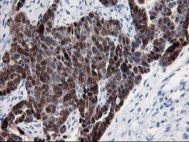 HSPBP1 Antibody - IHC of paraffin-embedded Adenocarcinoma of Human ovary tissue using anti-HSPBP1 mouse monoclonal antibody.