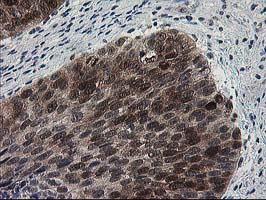 HSPBP1 Antibody - IHC of paraffin-embedded Carcinoma of Human bladder tissue using anti-HSPBP1 mouse monoclonal antibody.