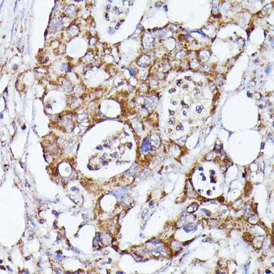 HSPC167 / CDK5RAP1 Antibody - Immunohistochemistry of paraffin-embedded Human colon carcinoma using CDK5RAP1 Polyclonal Antibody at dilution of 1:100 (40x lens).