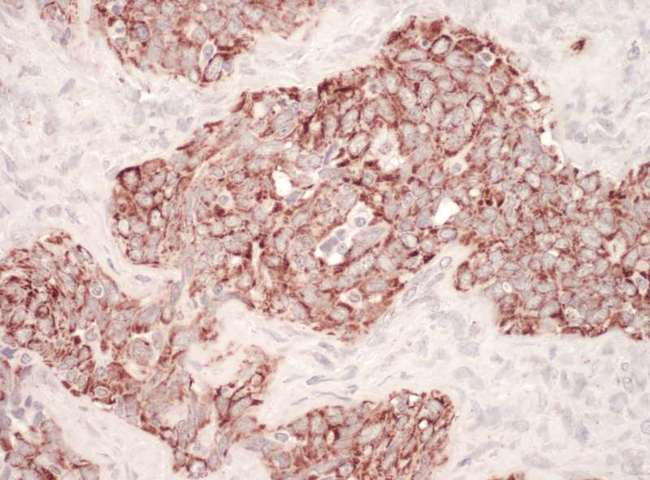 HSPD1 / HSP60 Antibody - Detection of Human HSP60 by Immunohistochemistry. Sample: FFPE section of human ovarian carcinoma. Antibody: Affinity purified rabbit anti-HSP60 used at a dilution of 1:200 (1 ug/ml). Detection: Vector Laboratories ImmPACT NovaRED Peroxidase Substrate.