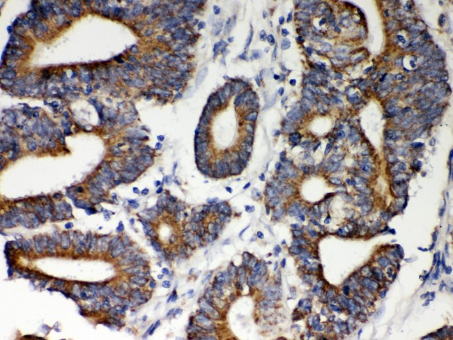 HSPD1 / HSP60 Antibody - Hsp60 antibody IHC-paraffin: Human Intestinal Cancer Tissue.