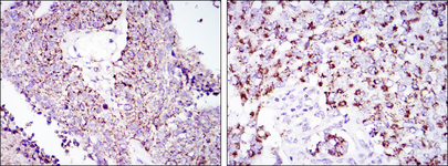 HSPD1 / HSP60 Antibody - IHC of paraffin-embedded lung cancer tissues (left) and kidney cancer tissues (right) using HSP60 mouse monoclonal antibody with DAB staining.