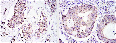HSPD1 / HSP60 Antibody - IHC of paraffin-embedded breast cancer tissues (left) and colon cancer tissues (right) using HSP60 mouse monoclonal antibody with DAB staining.