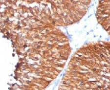 HSPD1 / HSP60 Antibody - Formalin-fixed, paraffin-embedded human bladder carcinoma stained with HSP60 antibody (HSPD1/780).  This image was taken for the unmodified form of this product. Other forms have not been tested.