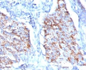 HSPD1 / HSP60 Antibody - Formalin-fixed, paraffin-embedded human lung carcinoma stained with HSP60 antibody (HSPD1/780).  This image was taken for the unmodified form of this product. Other forms have not been tested.