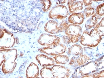 HSPD1 / HSP60 Antibody - Formalin-fixed, paraffin-embedded human renal cell carcinoma stained with HSP60 antibody (HSPD1/780).  This image was taken for the unmodified form of this product. Other forms have not been tested.