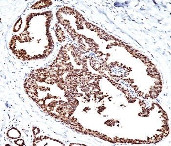 HSPD1 / HSP60 Antibody - HSP60 antibody LK1 immunohistochemistry breast carcinoma.  This image was taken for the unmodified form of this product. Other forms have not been tested.