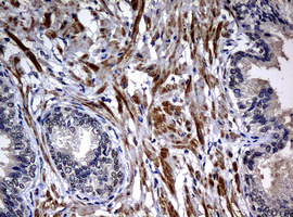 HSPD1 / HSP60 Antibody - IHC of paraffin-embedded Carcinoma of Human prostate tissue using anti-HSPD1 mouse monoclonal antibody.