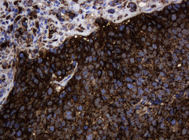 HSPD1 / HSP60 Antibody - IHC of paraffin-embedded Carcinoma of Human lung tissue using anti-HSPD1 mouse monoclonal antibody.