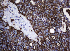 HSPD1 / HSP60 Antibody - IHC of paraffin-embedded Adenocarcinoma of Human ovary tissue using anti-HSPD1 mouse monoclonal antibody.
