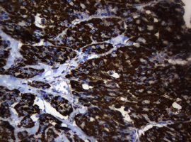 HSPD1 / HSP60 Antibody - IHC of paraffin-embedded Carcinoma of Human thyroid tissue using anti-HSPD1 mouse monoclonal antibody.