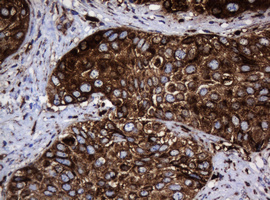 HSPD1 / HSP60 Antibody - IHC of paraffin-embedded Carcinoma of Human bladder tissue using anti-HSPD1 mouse monoclonal antibody.