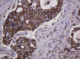 HSPD1 / HSP60 Antibody - IHC of paraffin-embedded Adenocarcinoma of Human breast tissue using anti-HSPD1 mouse monoclonal antibody.