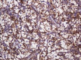 HSPD1 / HSP60 Antibody - IHC of paraffin-embedded Carcinoma of Human kidney tissue using anti-HSPD1 mouse monoclonal antibody.