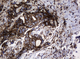 HSPD1 / HSP60 Antibody - IHC of paraffin-embedded Adenocarcinoma of Human breast tissue using anti-HSPD1 mouse monoclonal antibody.