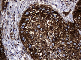 HSPD1 / HSP60 Antibody - IHC of paraffin-embedded Carcinoma of Human bladder tissue using anti-HSPD1 mouse monoclonal antibody.