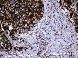 HSPD1 / HSP60 Antibody - IHC of paraffin-embedded Adenocarcinoma of Human colon tissue using anti-HSPD1 mouse monoclonal antibody.