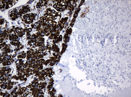 HSPD1 / HSP60 Antibody - IHC of paraffin-embedded Carcinoma of Human liver tissue using anti-HSPD1 mouse monoclonal antibody.