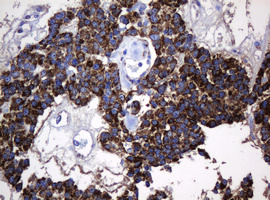 HSPD1 / HSP60 Antibody - IHC of paraffin-embedded Carcinoma of Human pancreas tissue using anti-HSPD1 mouse monoclonal antibody.