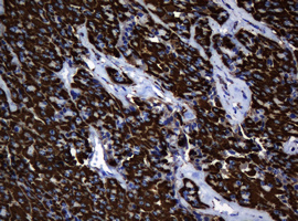 HSPD1 / HSP60 Antibody - IHC of paraffin-embedded Carcinoma of Human thyroid tissue using anti-HSPD1 mouse monoclonal antibody.