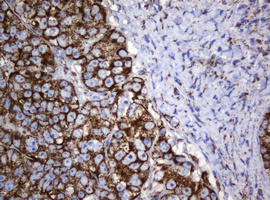 HSPD1 / HSP60 Antibody - IHC of paraffin-embedded Adenocarcinoma of Human colon tissue using anti-HSPD1 mouse monoclonal antibody.