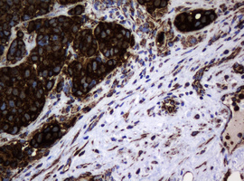 HSPD1 / HSP60 Antibody - IHC of paraffin-embedded Carcinoma of Human lung tissue using anti-HSPD1 mouse monoclonal antibody.
