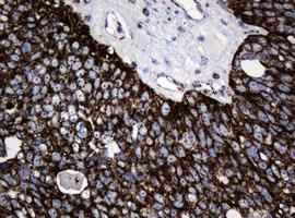 HSPD1 / HSP60 Antibody - IHC of paraffin-embedded Adenocarcinoma of Human ovary tissue using anti-HSPD1 mouse monoclonal antibody.