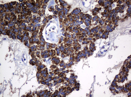 HSPD1 / HSP60 Antibody - IHC of paraffin-embedded Carcinoma of Human pancreas tissue using anti-HSPD1 mouse monoclonal antibody.
